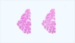 Frozen Tissue Section - Pulmonary Embolism: Lung