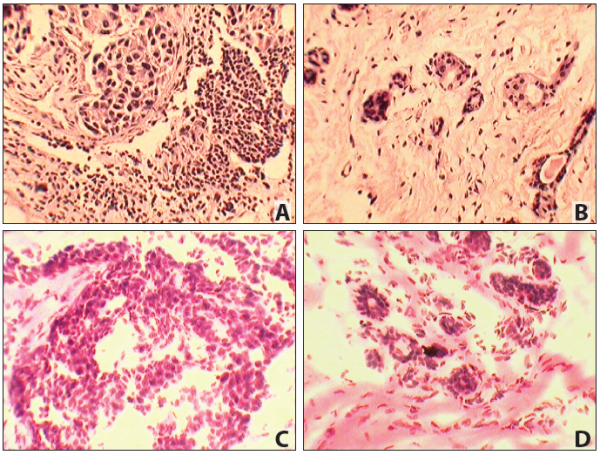 Matched Pair - Paraffin Tissue Section - Human Primary and Matched Metastatic Tumor (PM): Rectum